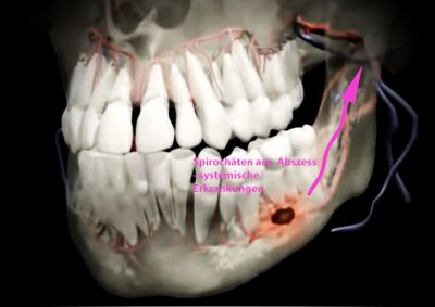 Spirochäten aus Abszess - systemische Erkrankungen