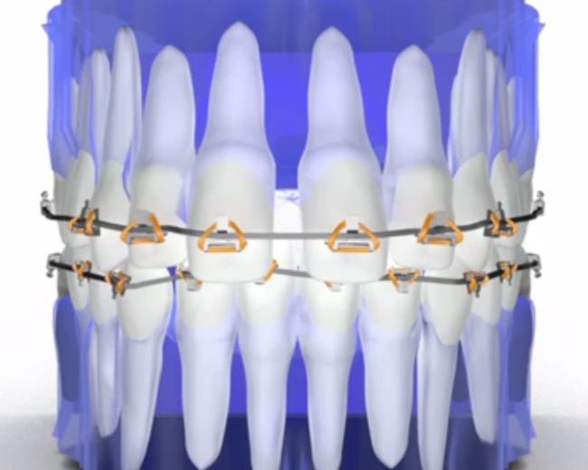 Zahnfehlstellungen im Lückengebiß korrigieren  - Teil 5