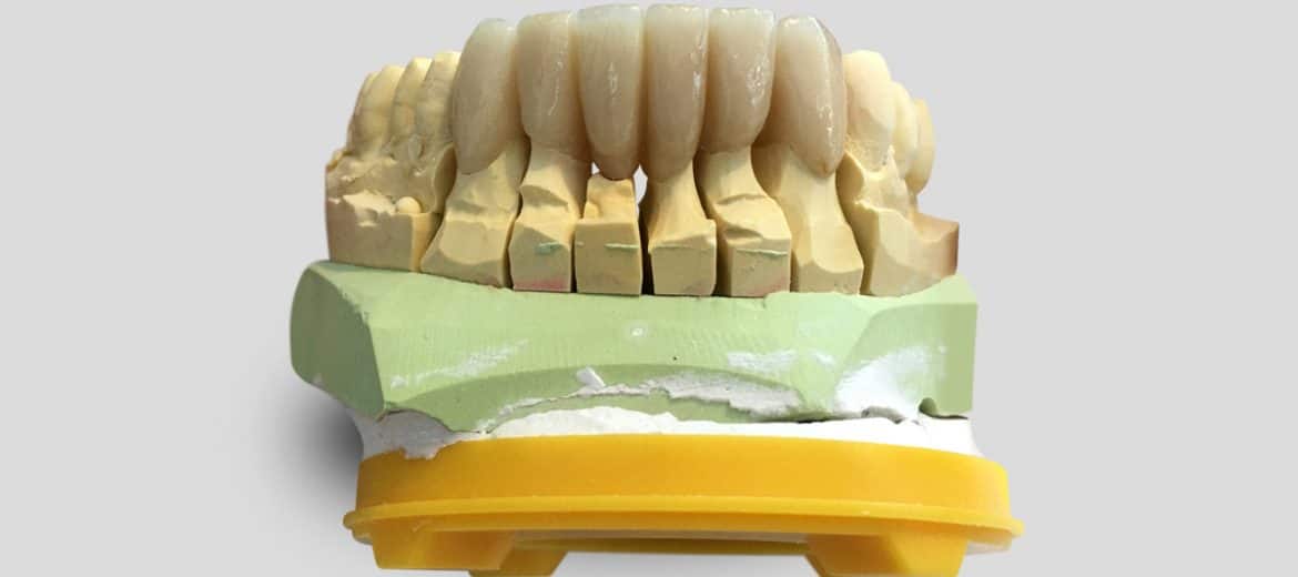 Unsichtbare Zahnrestaurationen mit Vollkeramik: