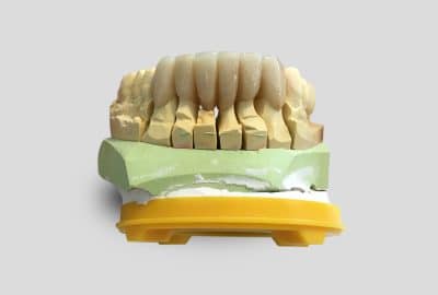 Unsichtbare Zahnrestaurationen mit Vollkeramik: