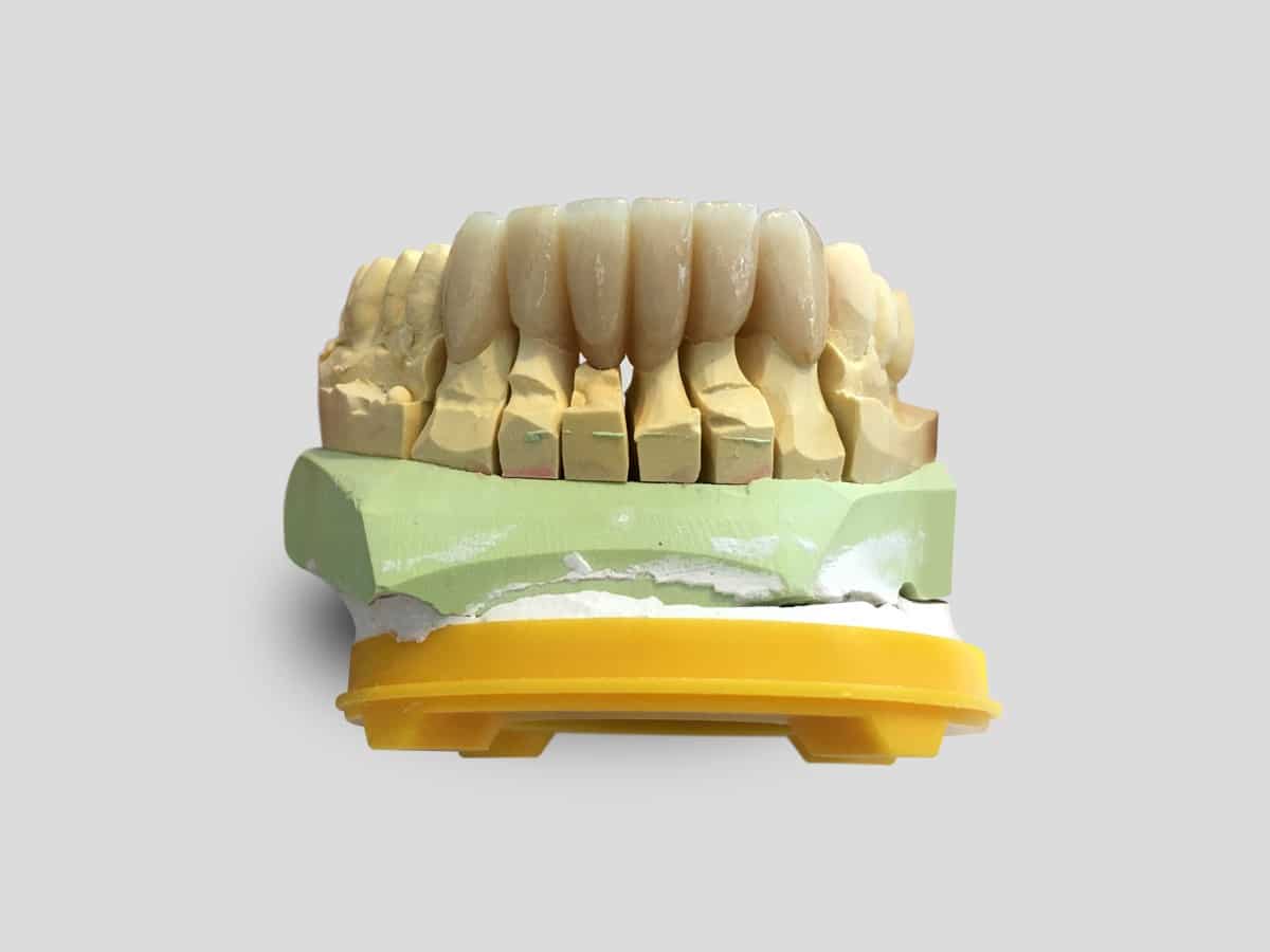 Unsichtbare Zahnrestaurationen mit Vollkeramik
