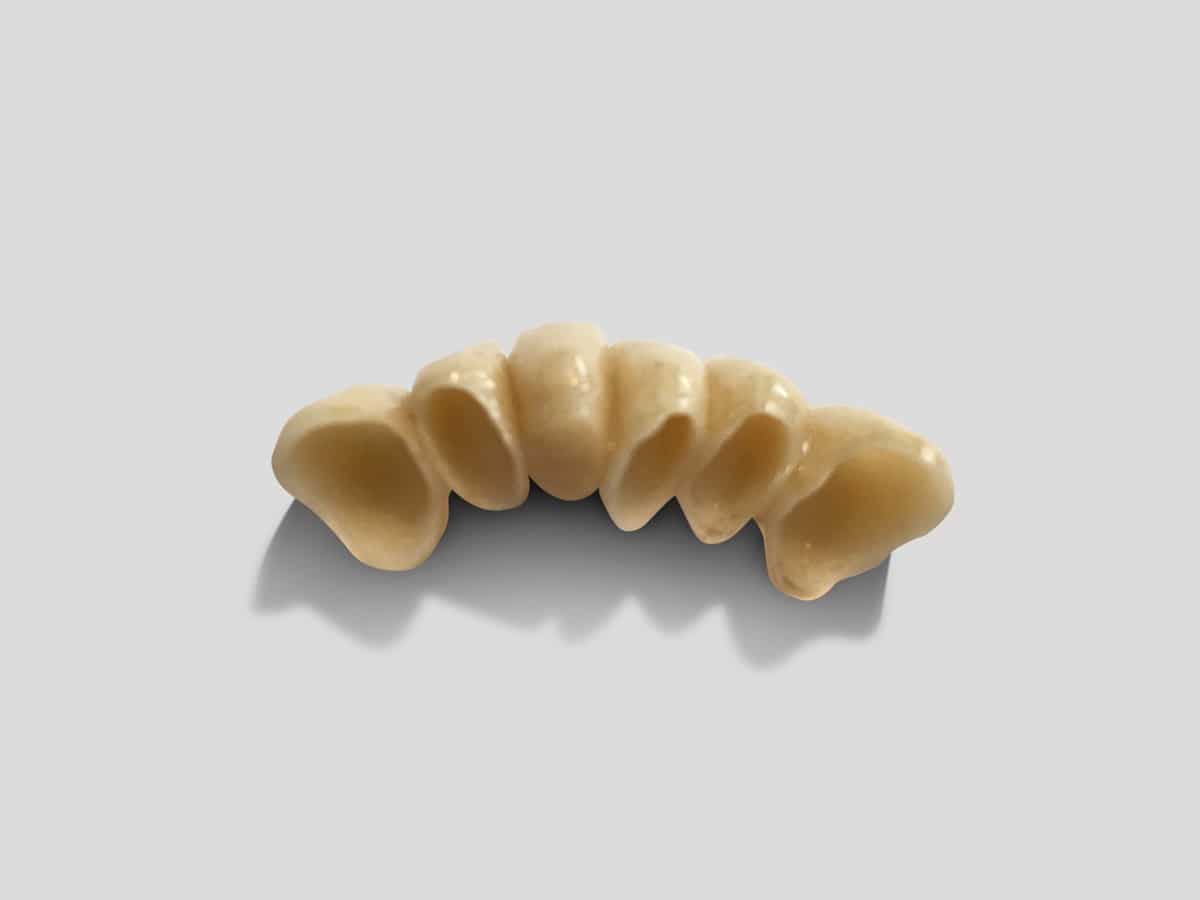 Unsichtbare Zahnrestaurationen mit Vollkeramik